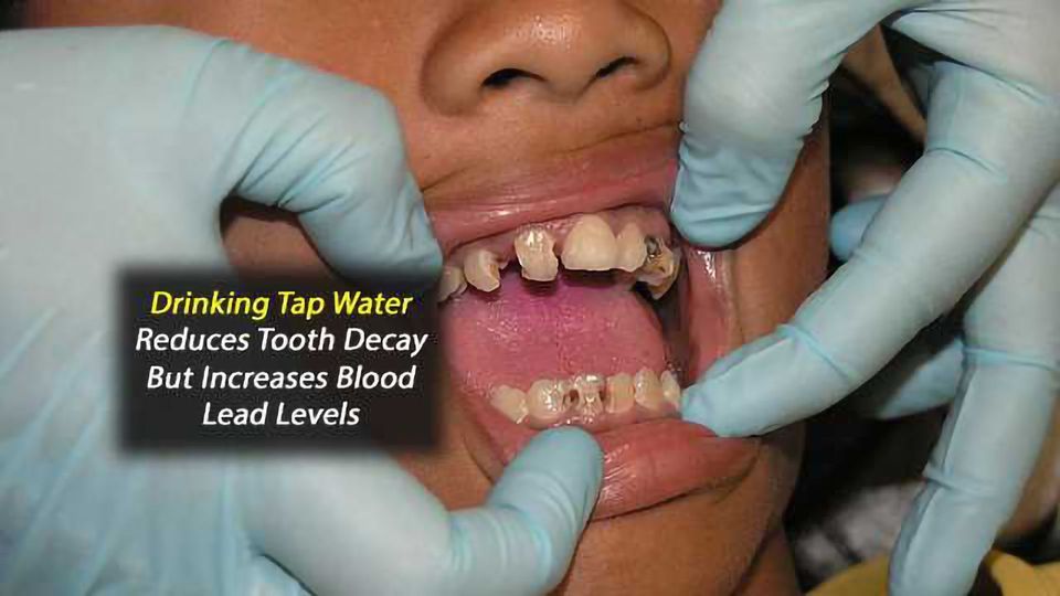 Blood Lead Levels Lower, But Tooth Decay Higher in Children Who Do Not Drink Tap Water content piece image